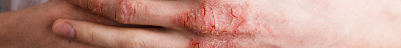 Understand Eczema Page Banner